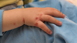 mild hand foot and mouth disease adult